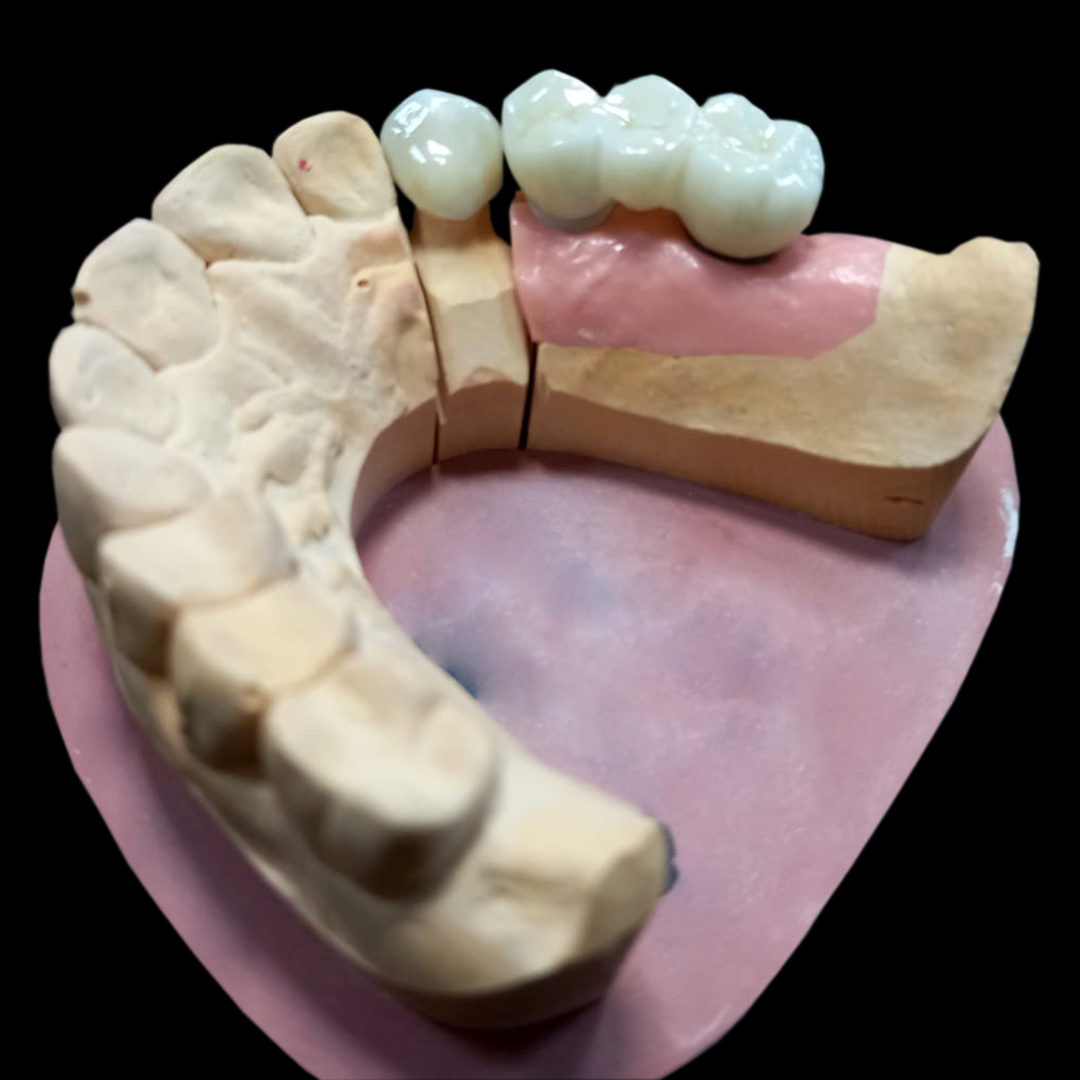 tselnokeramicheskiy_most_s_oporoy_na_implantat