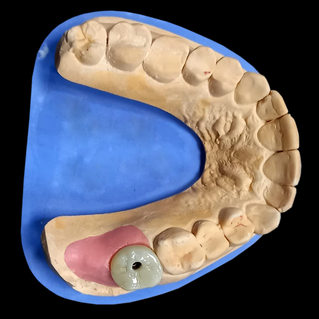 Vremennaya_koronka_PMMA_na_implant_1