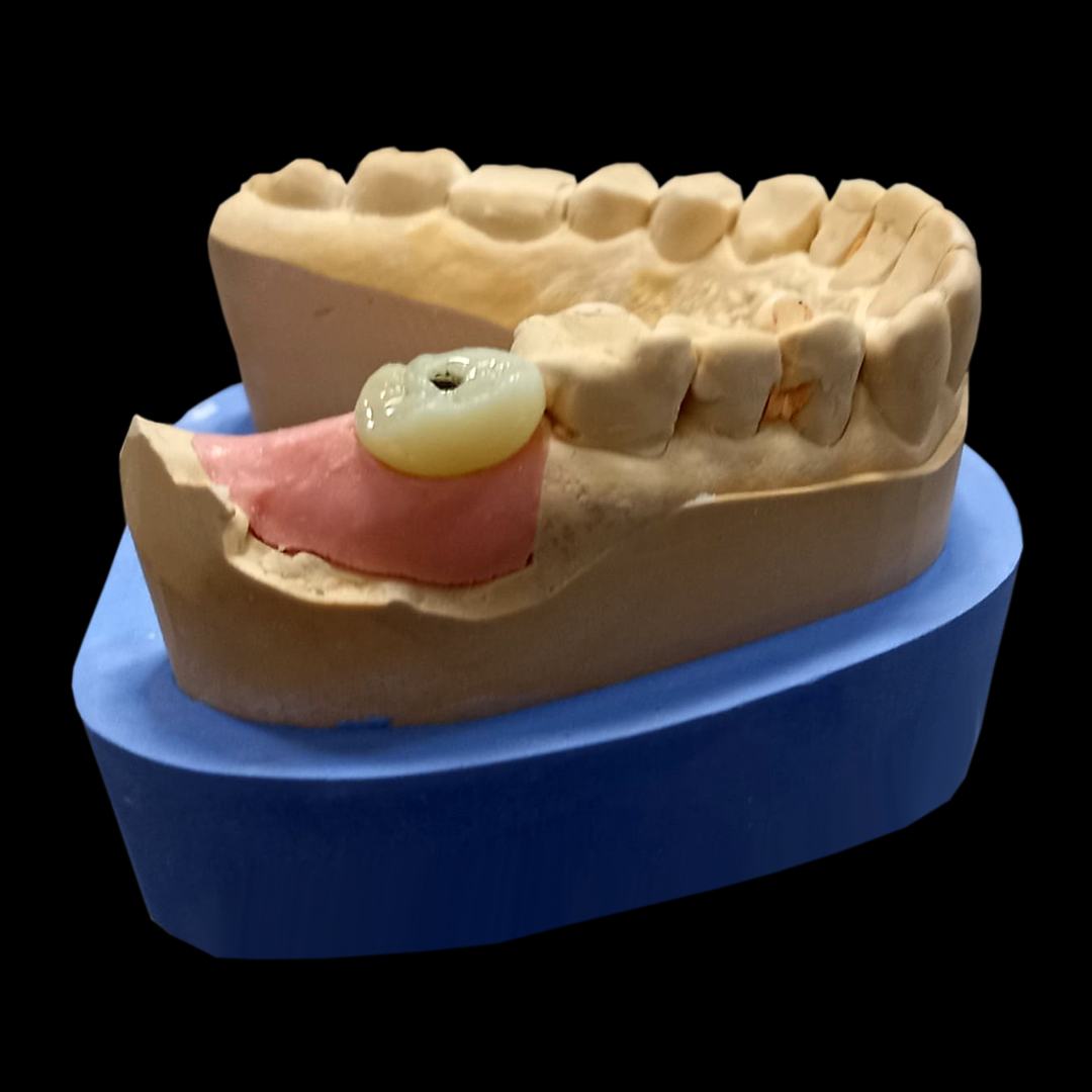 Vremennaya_koronka_PMMA_na_implant_2