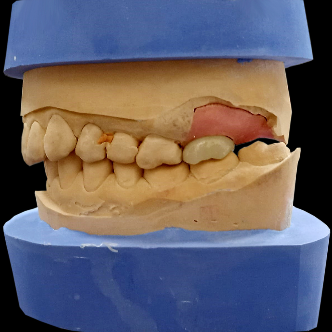 Vremennaya_koronka_PMMA_na_implant_3